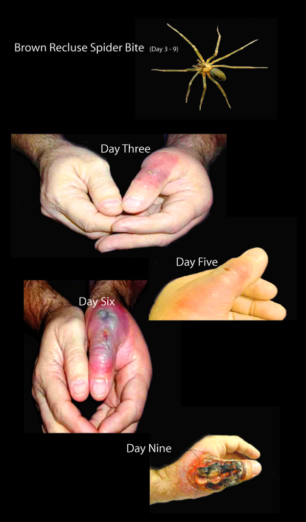 Progress of Brown Recluse Spider Bite.  Click on picture for first aid information. 